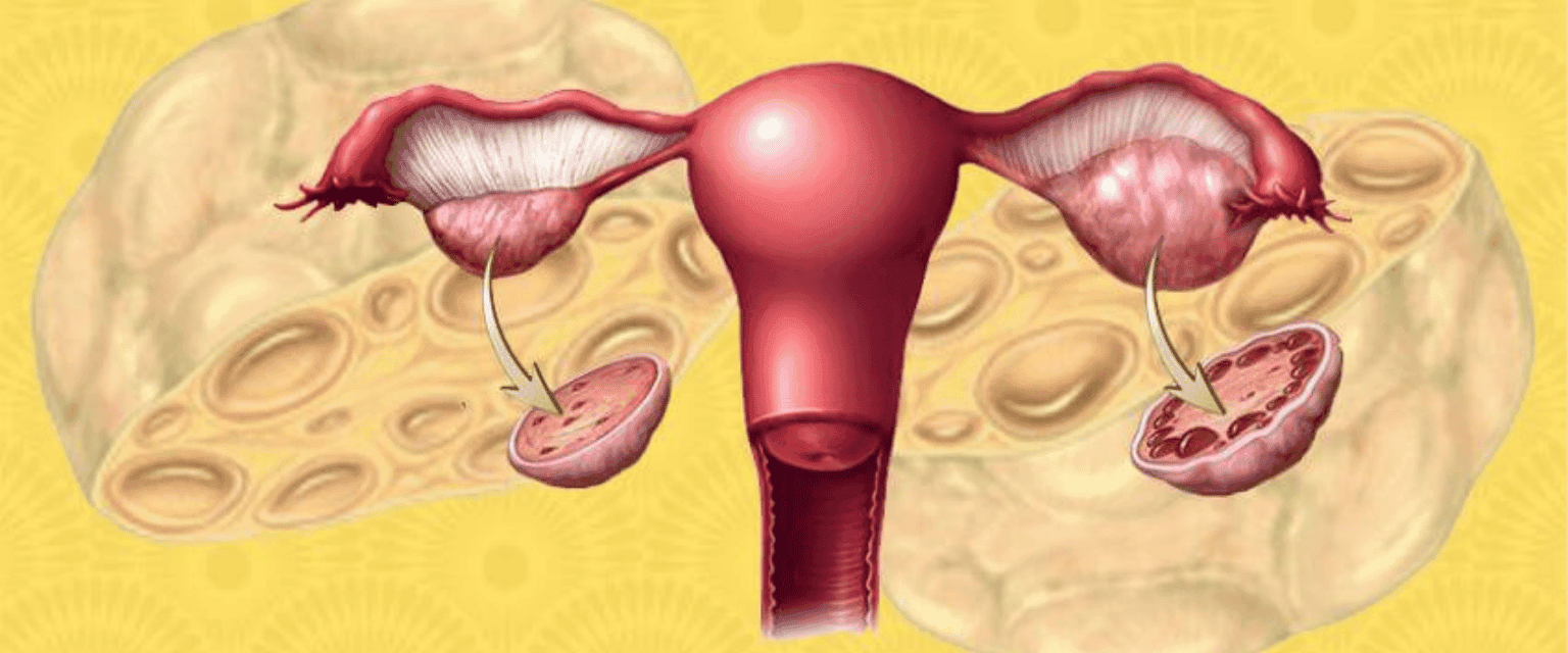 WHAT IS POLYCYSTIC OVARIAN SYNDROME (PCOS)?