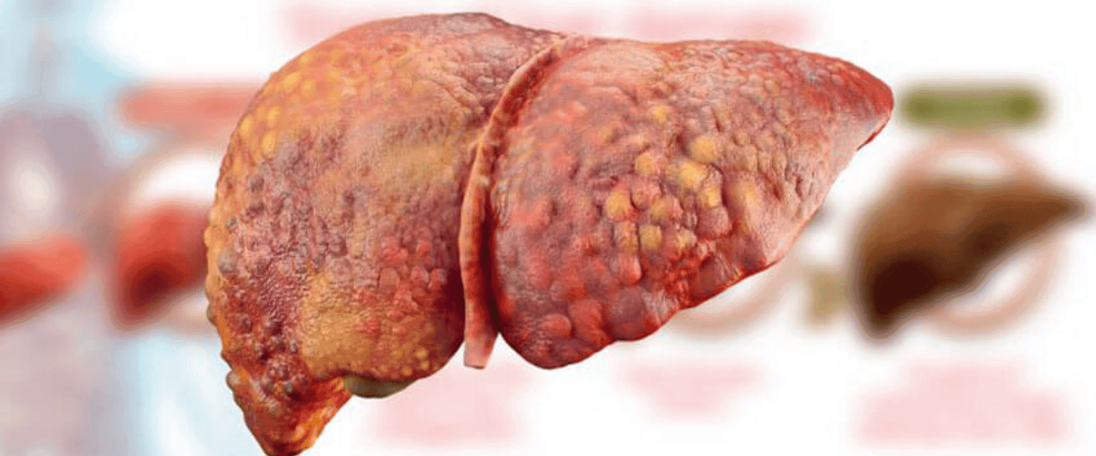ON WORLD CIRRHOSIS DAY- 10 POINTS ON THE LIVER DISEASES