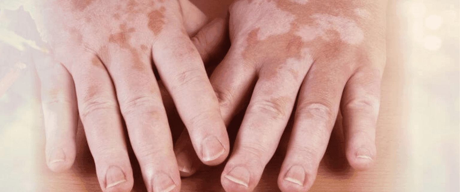 What is Skin Care  Vitiligo (Leucoderma)? Explains Dermatologist