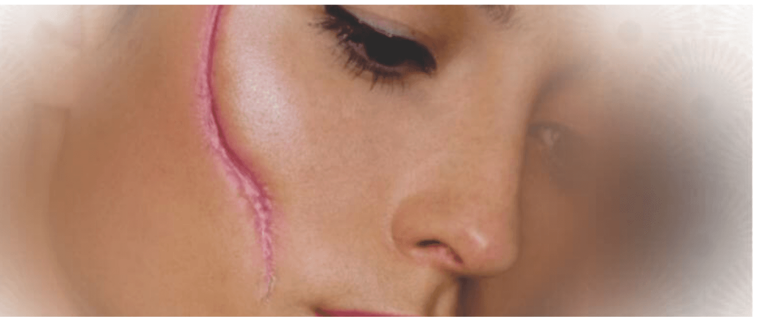 Why Scars??