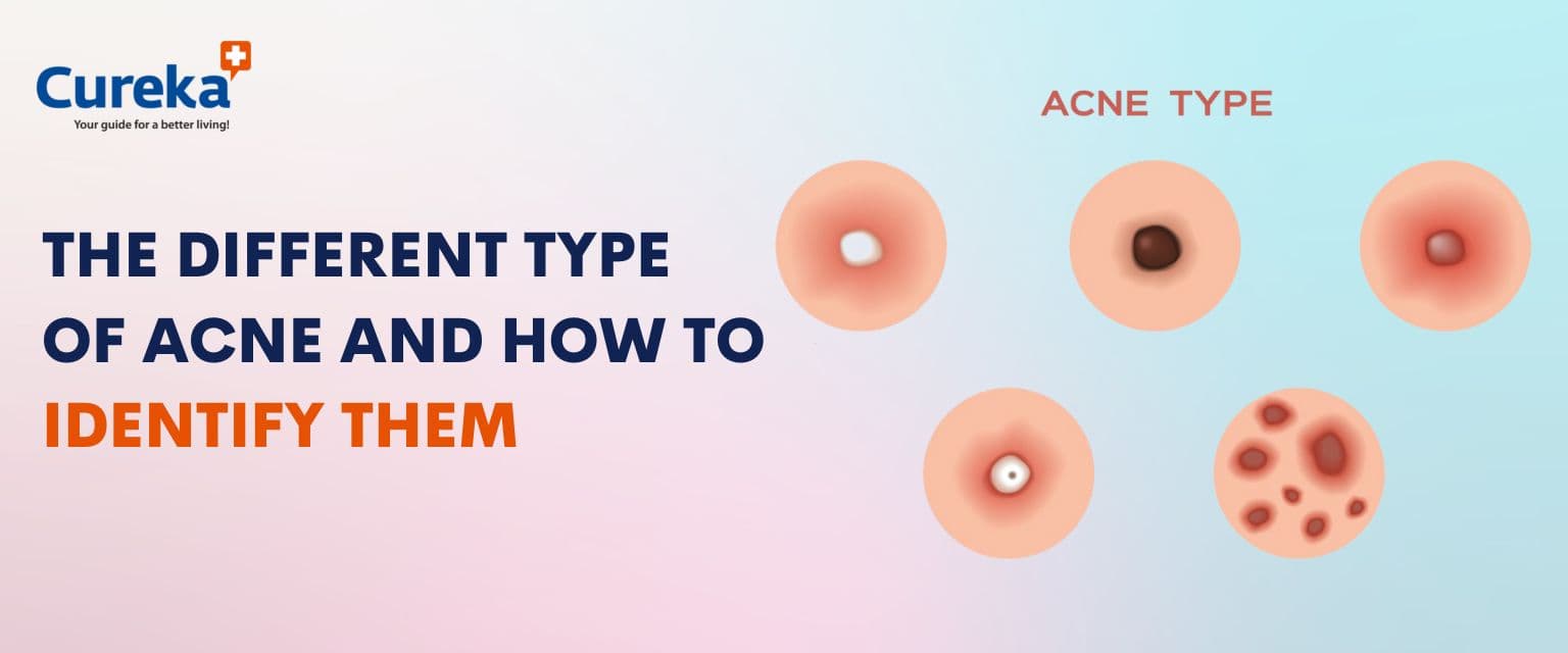 The Different Types of Acne and How to Identify Them