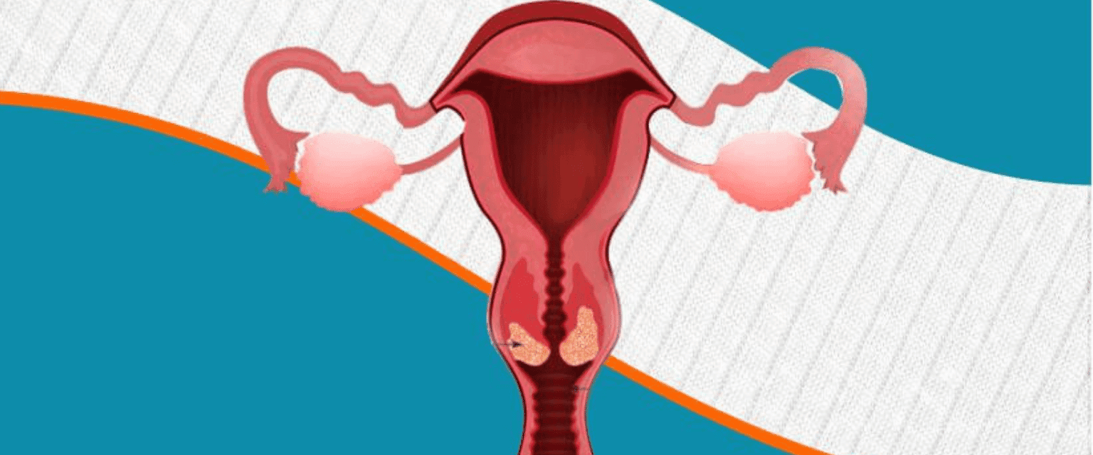 What Is Cervical Cancer?