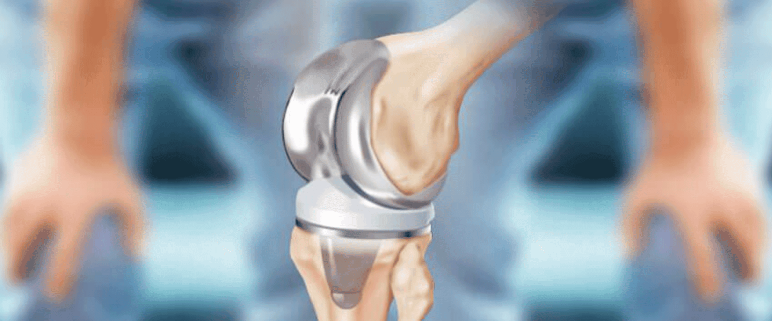 Joint Replacement Surgery A Successful Treatment